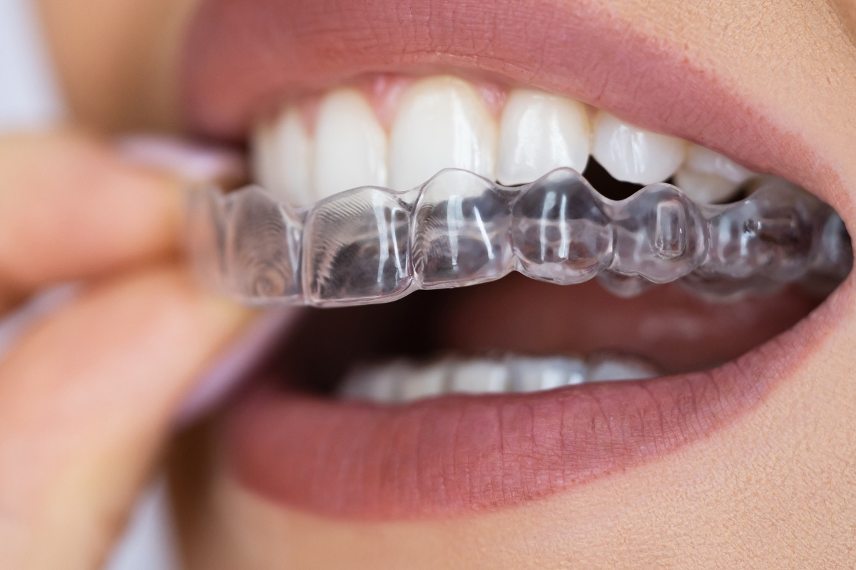 clear-aligners-in-Plant-City-FL
