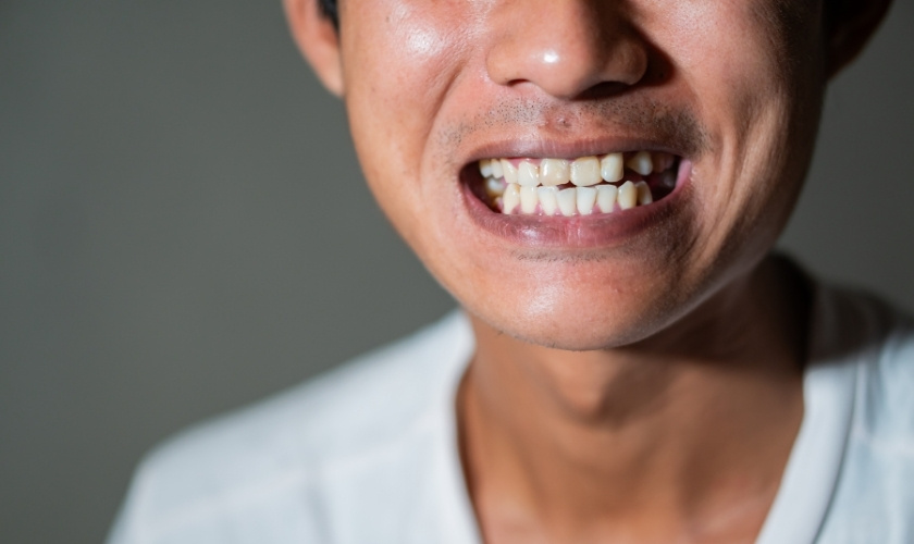 Gap Between Crown and Gum
