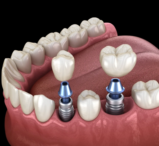 precision dental implants in Fort Worth & Haltom City