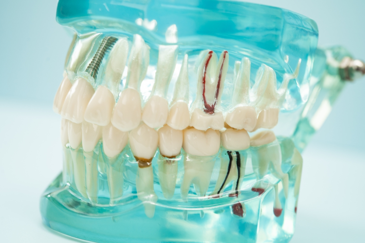 root canal procedure