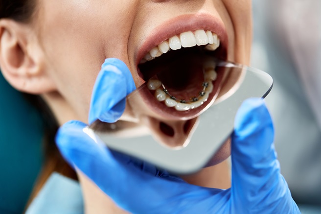dental fillings