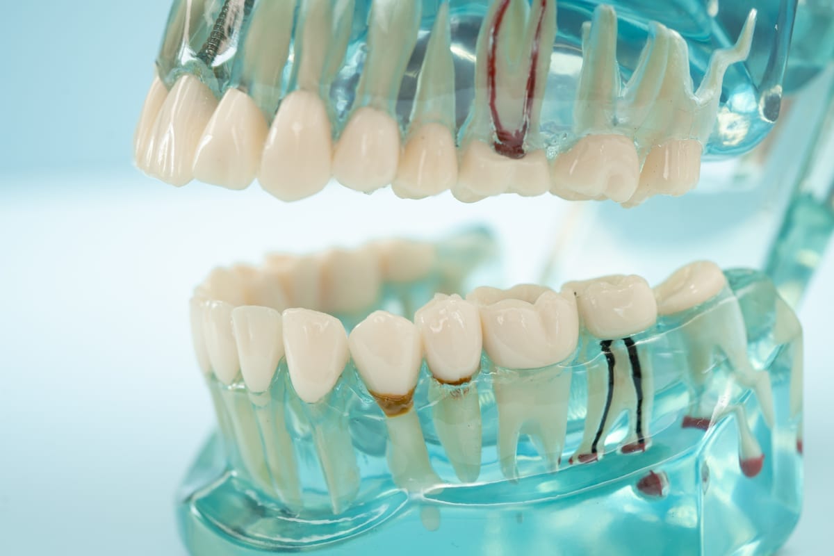 Root Canal Treatment in Saginaw