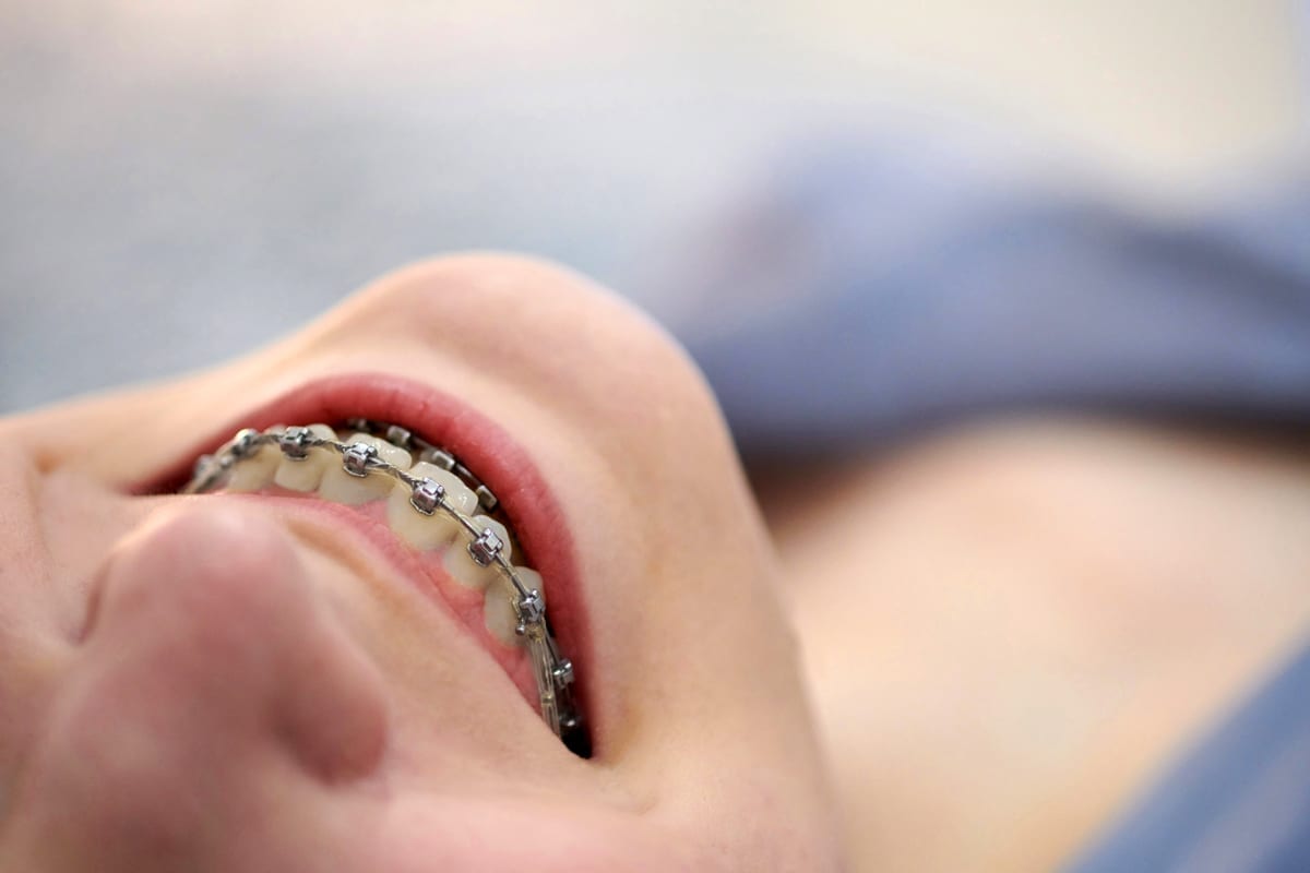 Braces in Haltom City