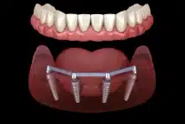 all on 4 implants