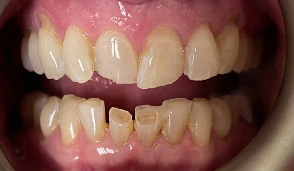 Patient teeth before Aspect Veneers showing crowding, worn edges, and fractured molars
