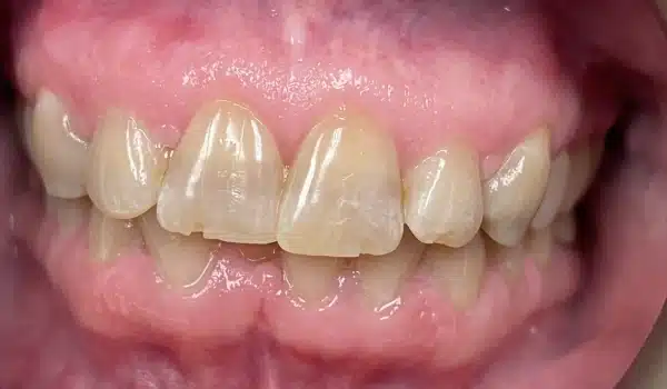 Teeth before dental treatment showing discoloration and damage