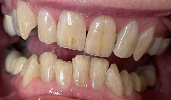 Teeth before dental treatment with discoloration and wear