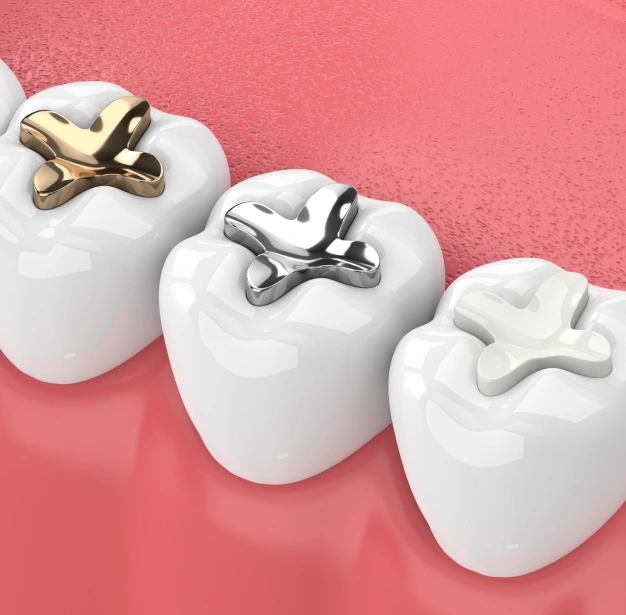 Composite Fillings