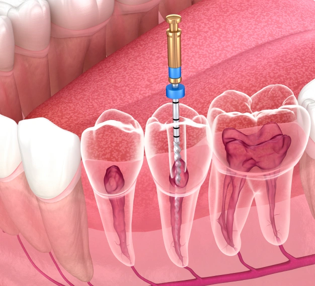 Endodontics