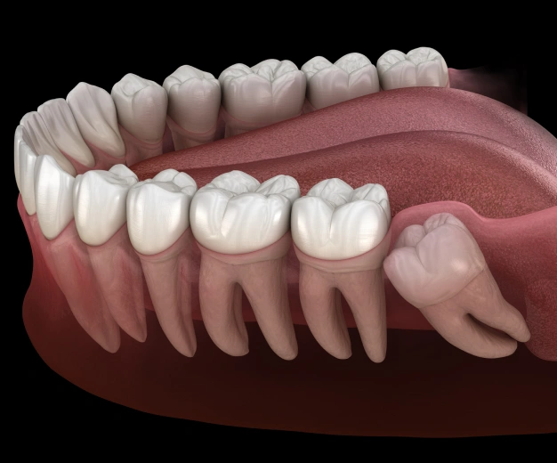 Wisdom Teeth