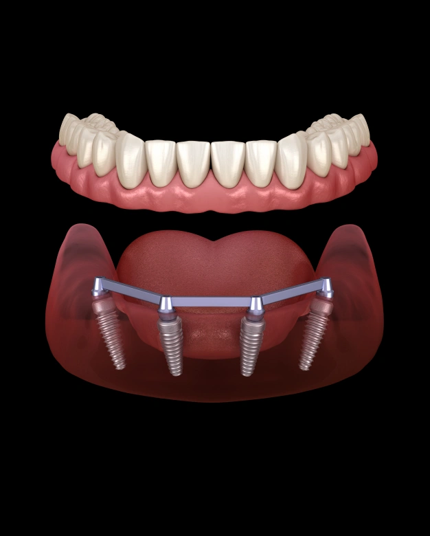 All-on-4 dental implant illustration showing prosthetic teeth on implant bar with jawbone.
