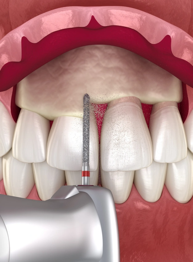 Crown lengthening procedure illustration showing gum tissue removal with dental tool between front teeth.