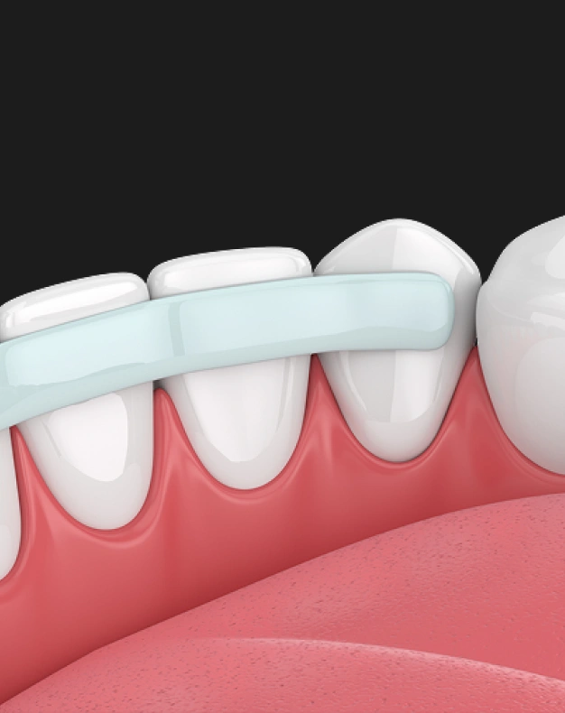 Animated illustration of dental bonding showing a toothbrush cleaning whitened teeth with healthy pink gums.