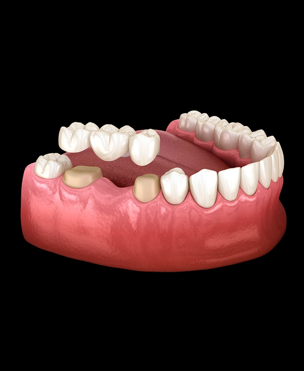 3D illustration of a dental bridge replacing missing teeth with natural-looking crowns on gum tissue.