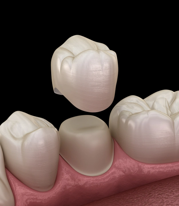 3D dental crowns illustration showing tooth-colored restorations on gum tissue model.