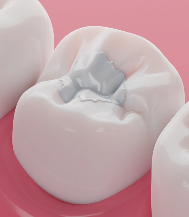 3D illustration of a tooth with dental filling material applied to a cavity.