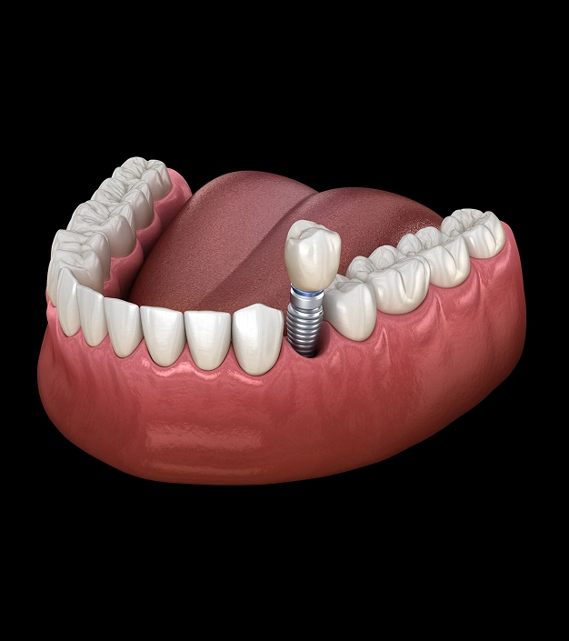 3D dental implant illustration showing tooth replacement with titanium screw and crown.