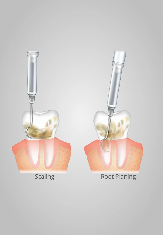 Dental scaling and root planing illustration showing tooth cleaning and root surface treatment procedures.