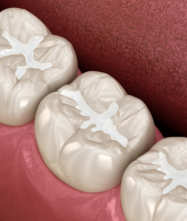 3D illustration of dental sealants applied to tooth surfaces with white fissure-sealing material.