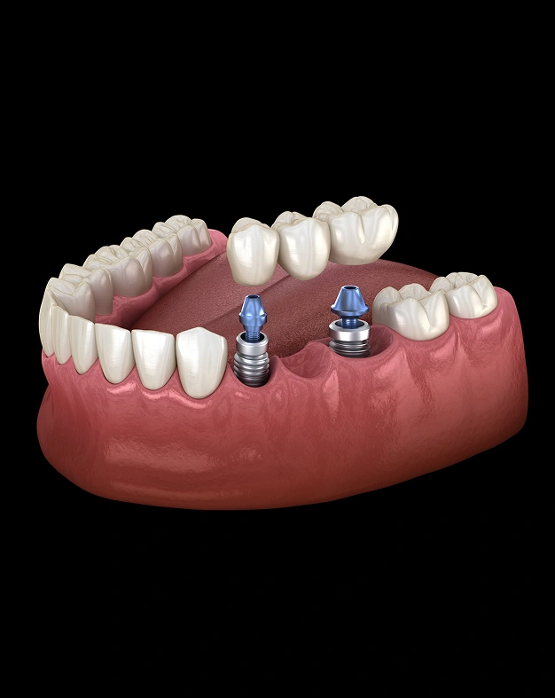 3D dental illustration of implant-supported bridge with two titanium implants and ceramic crowns in jawbone.