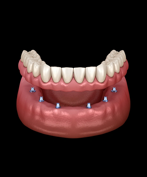 Implant-supported denture with six dental implants anchoring a full upper arch prosthesis.