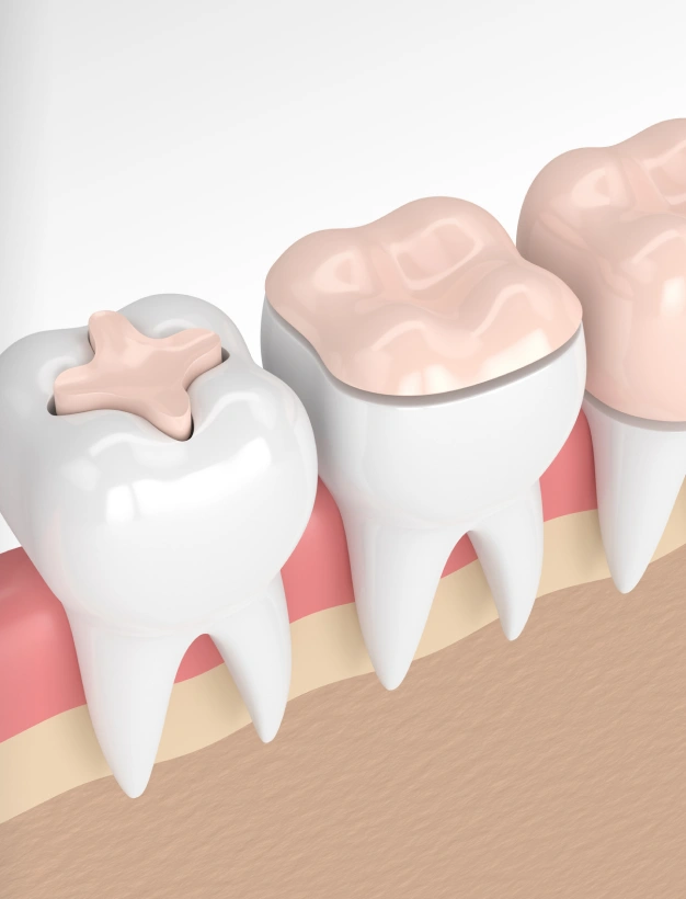 Illustration of dental inlays and onlays showing tooth restoration options for cavities and damage.