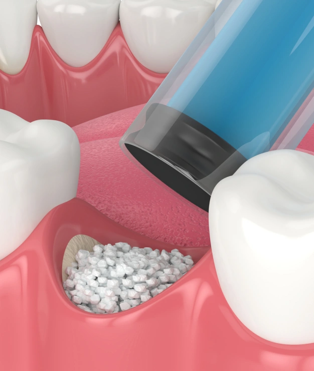 3D illustration of bone graft material being placed into a jaw defect during dental implant preparation.