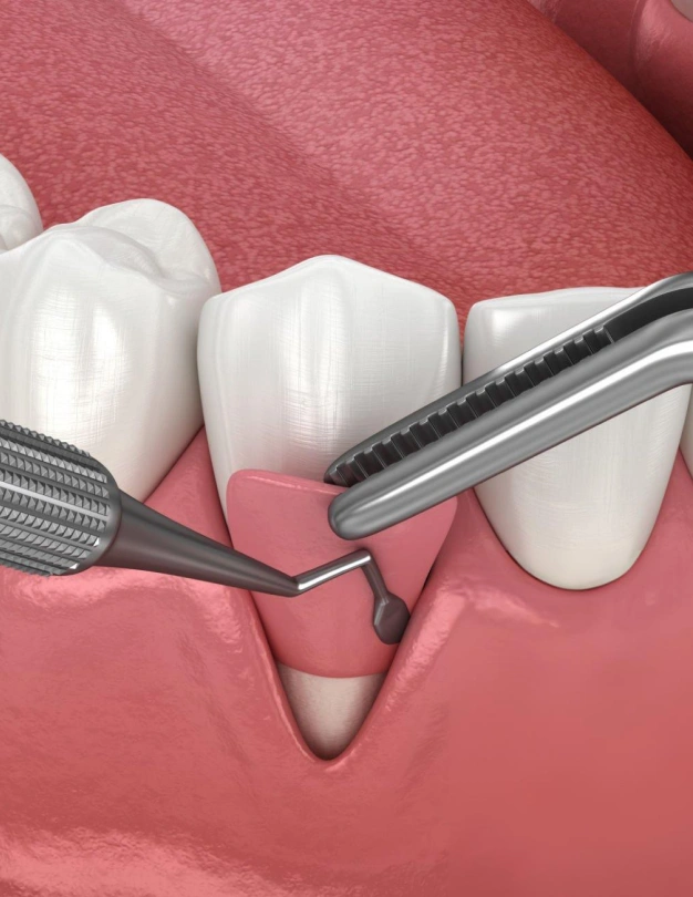 Gum grafting procedure showing dental instruments positioning graft material on receding gums.
