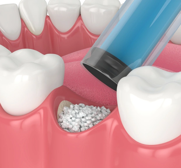 Bone Graft