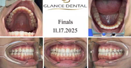 invisalign-after-1