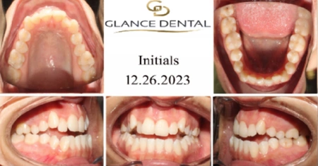 invisalign-before-1