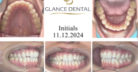 invisalign-before-2