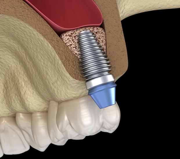 Sinus Lift