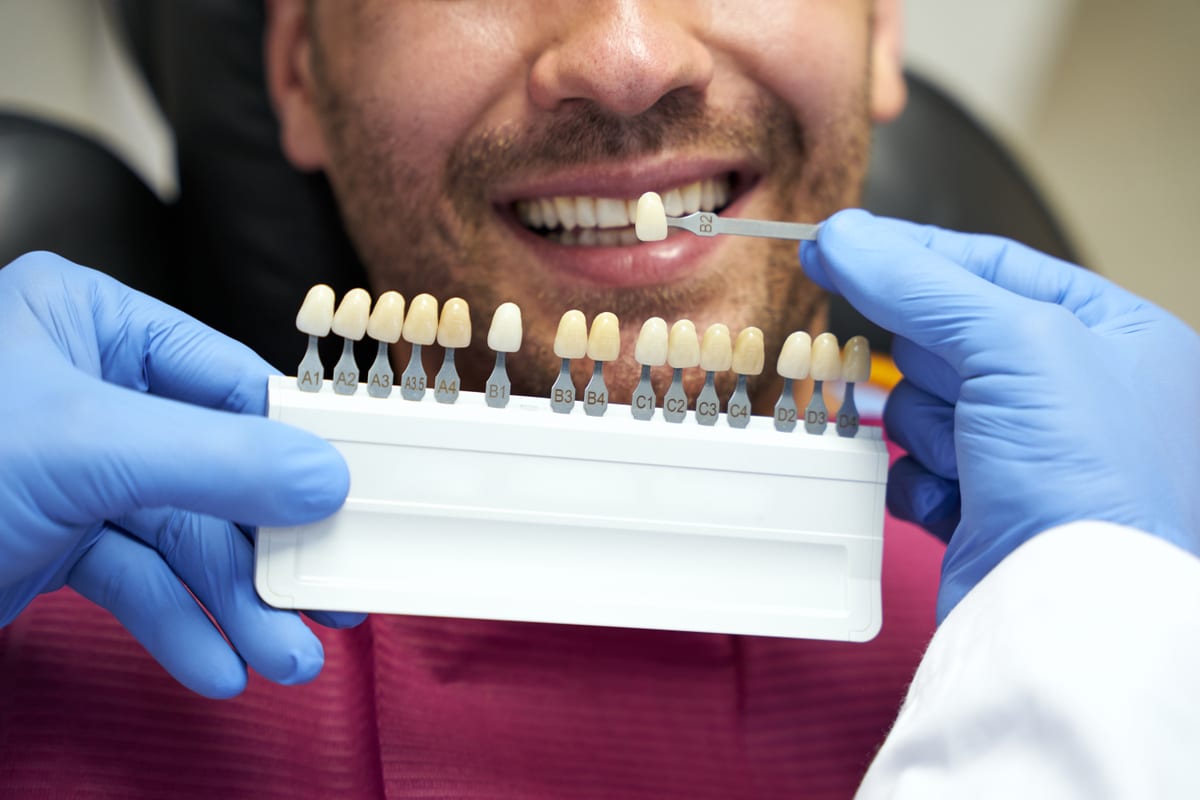 Veneers in Glendora
