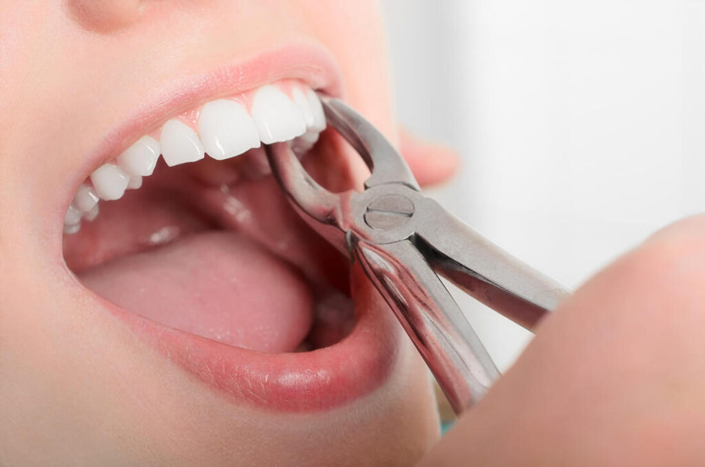after tooth extraction how long to heal