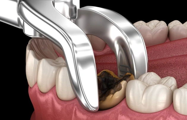 extractions-in-fort-lauderdale