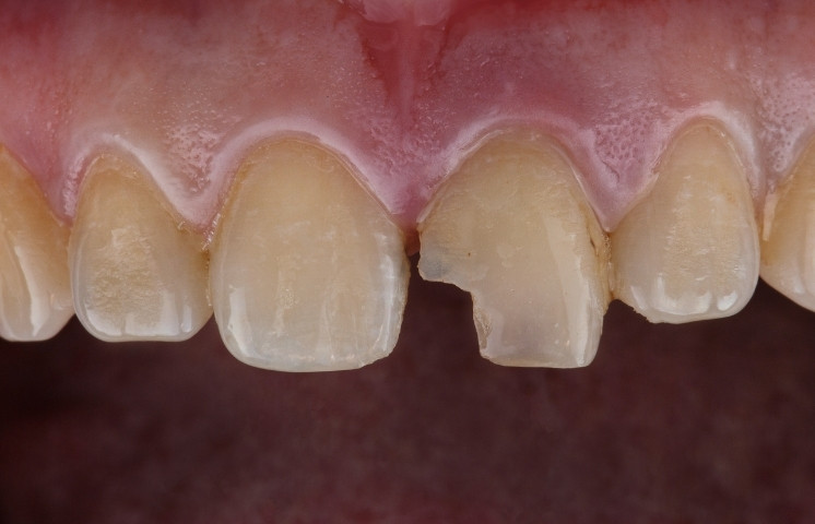 different options that can easily repair a chipped or broken tooth