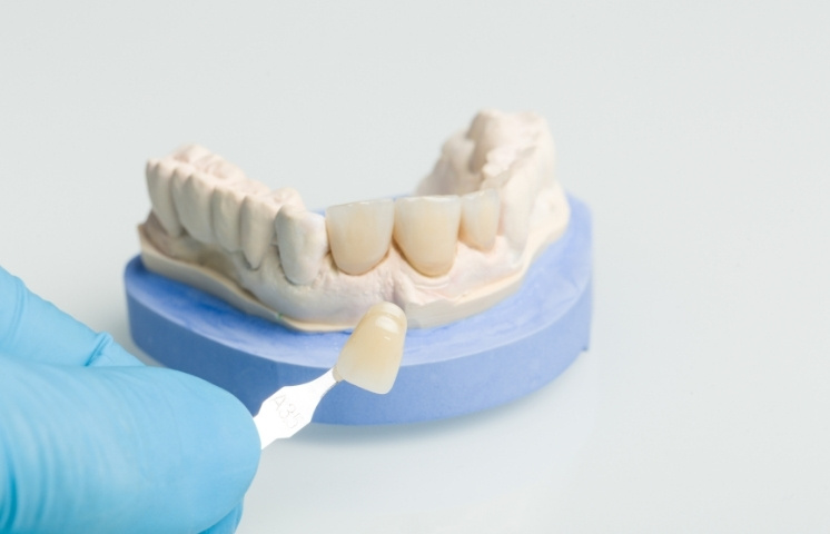 are dental veneers permanent or temporary