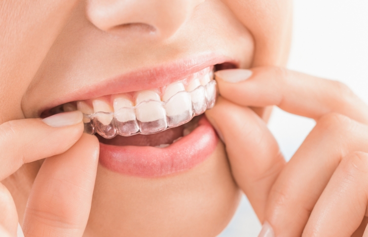 how the Invisalign treatment works