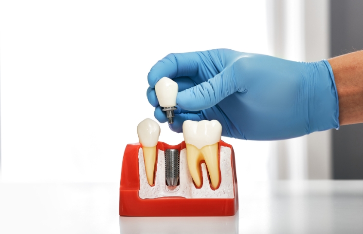 the signs that indicate your dental implant needs to be replaced