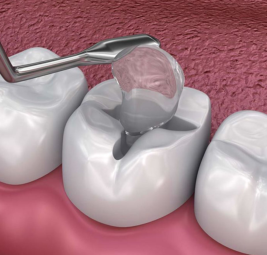 Dental sealants for cavities treatment