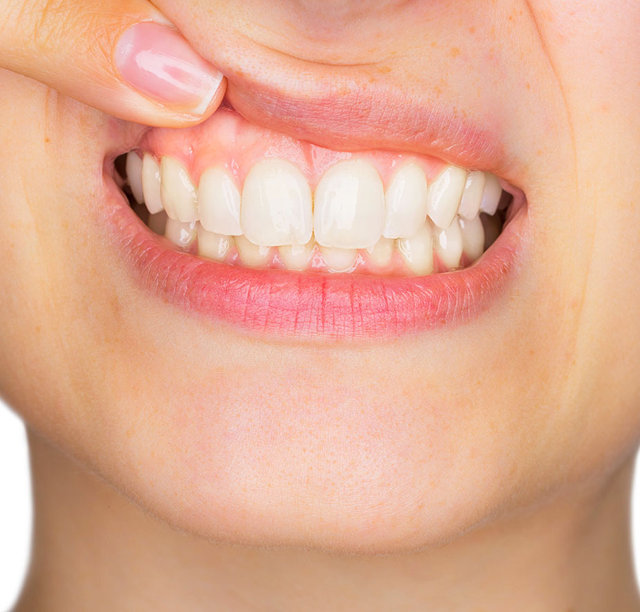 Patient at Hallmark Dental office for Periodontal Disease Treatment (Gum Disease)