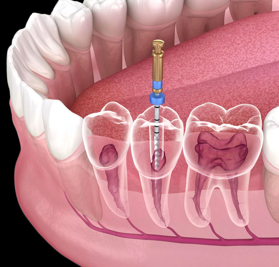 Root Canal Treatment at Hallmark Dental