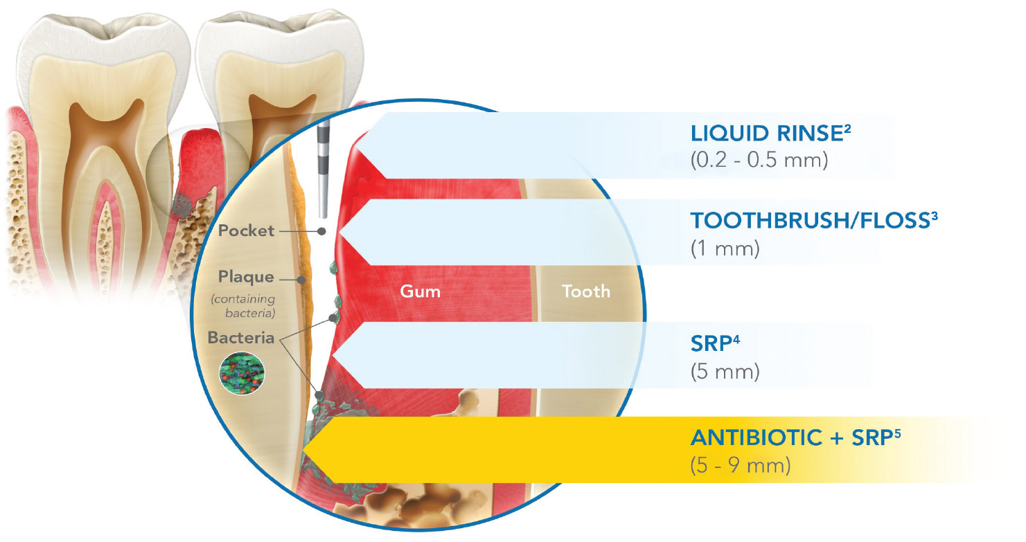ARESTIN + SRP can help. Bacteria Can Hide Out Of Reach