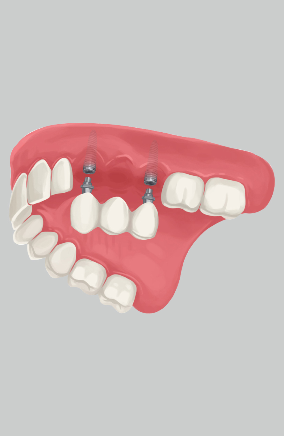 Conditions That Dental Implants Can Fix