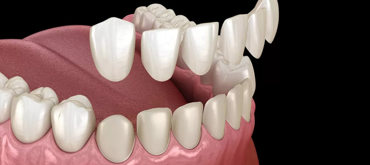 Dental Veneers