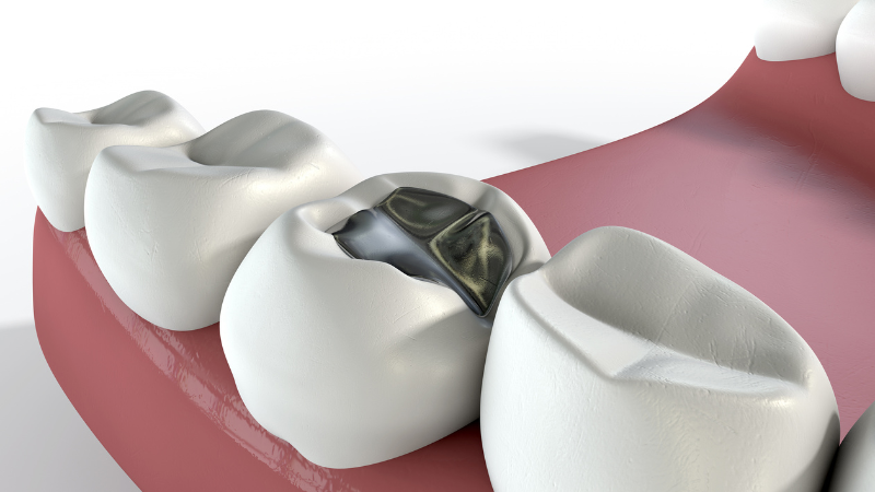 which type of filling is best for front teeth