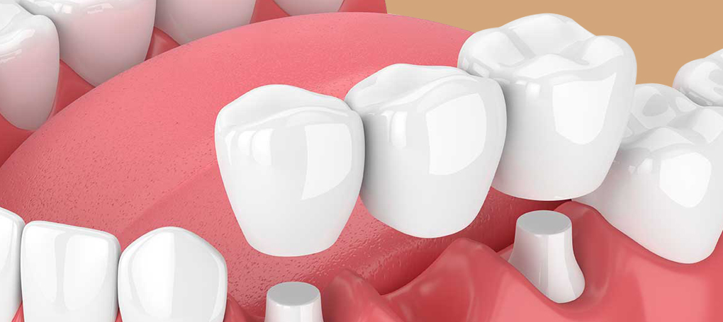 Dental crown in Brentwood and Lewisburg, TN