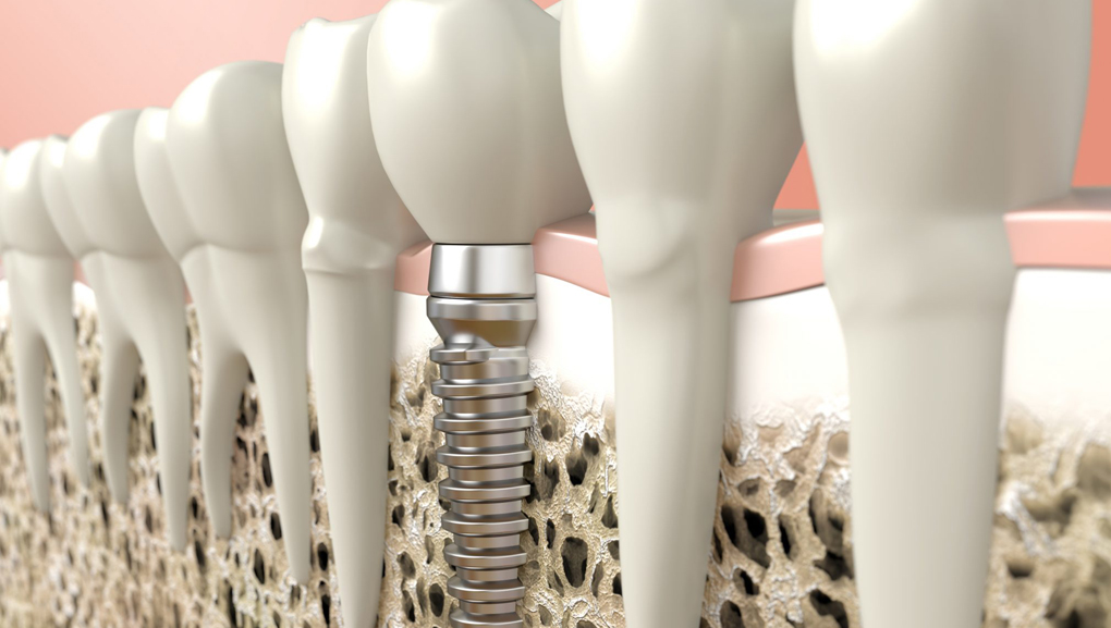 Dental implants in Brentwood and Lewisburg, TN