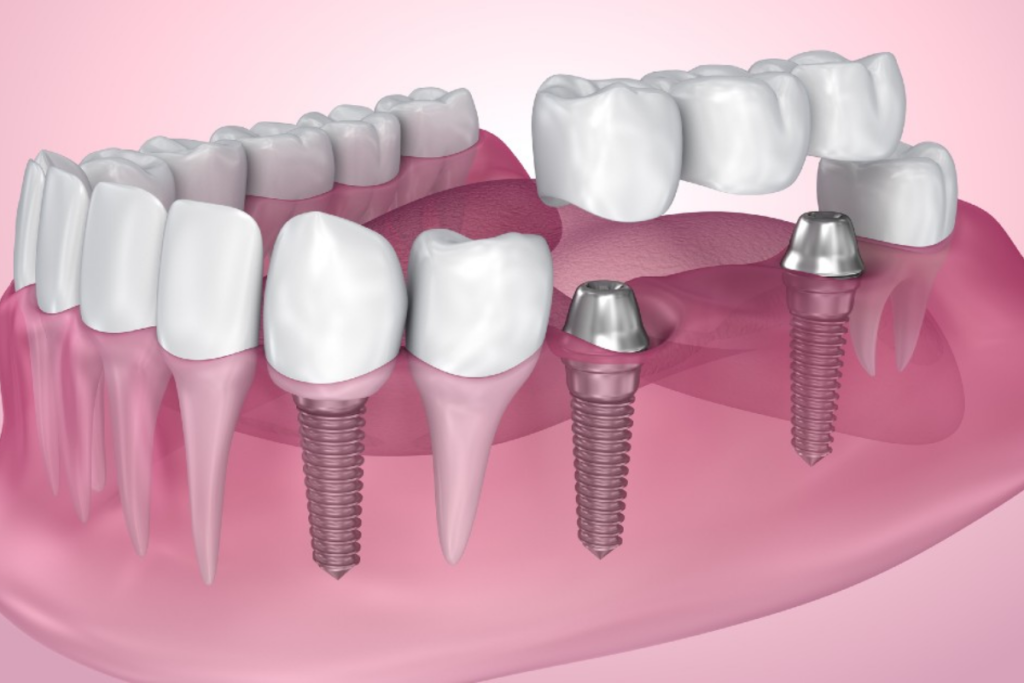 Dental Implants